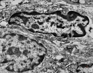 F,41y. | synovial metaplasia - capsule of implantate F,41y. | synovial metaplasia - capsule of implantate
